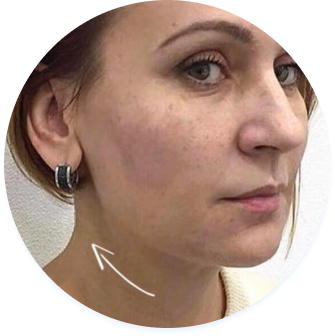 Фото обличчя після процедури