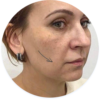 Фото обличчя до процедури